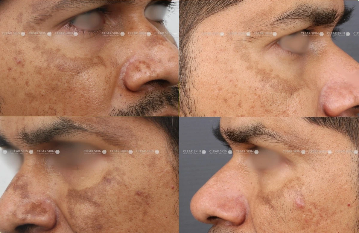 melasmaczyjestn-extra-1.webp Melasma: czy jest na nią lekarstwo? Zrozum, dlaczego inwestycja w kontrolę jest kluczowa - image 1