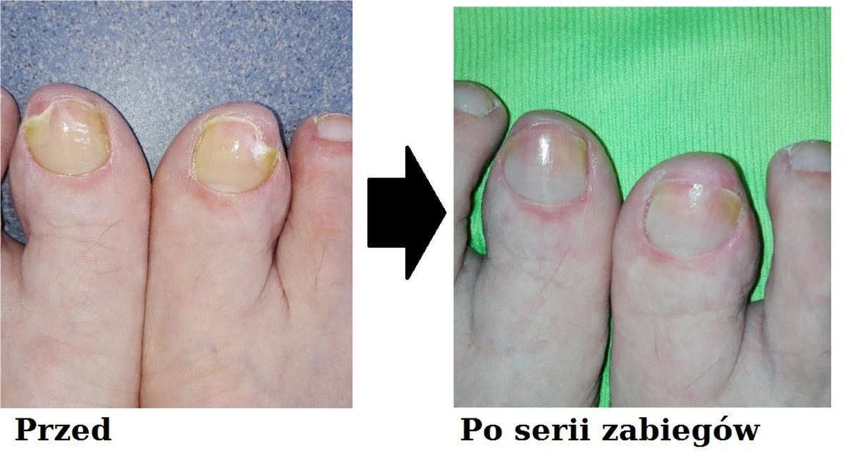 prostytrikzsusz-extra-1.webp Prosty trik z suszarką, który uratuje Twoje paznokcie u stóp – lepsze niż żaden krem! - image 1